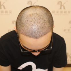 -大麦微针植发全国连锁