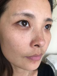 -美丽人生祛斑扁平疣汗管瘤中心