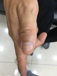 -德哥灰指甲脚气甲沟炎跖疣护理