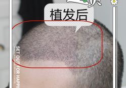 -大麦微针植发全国连锁