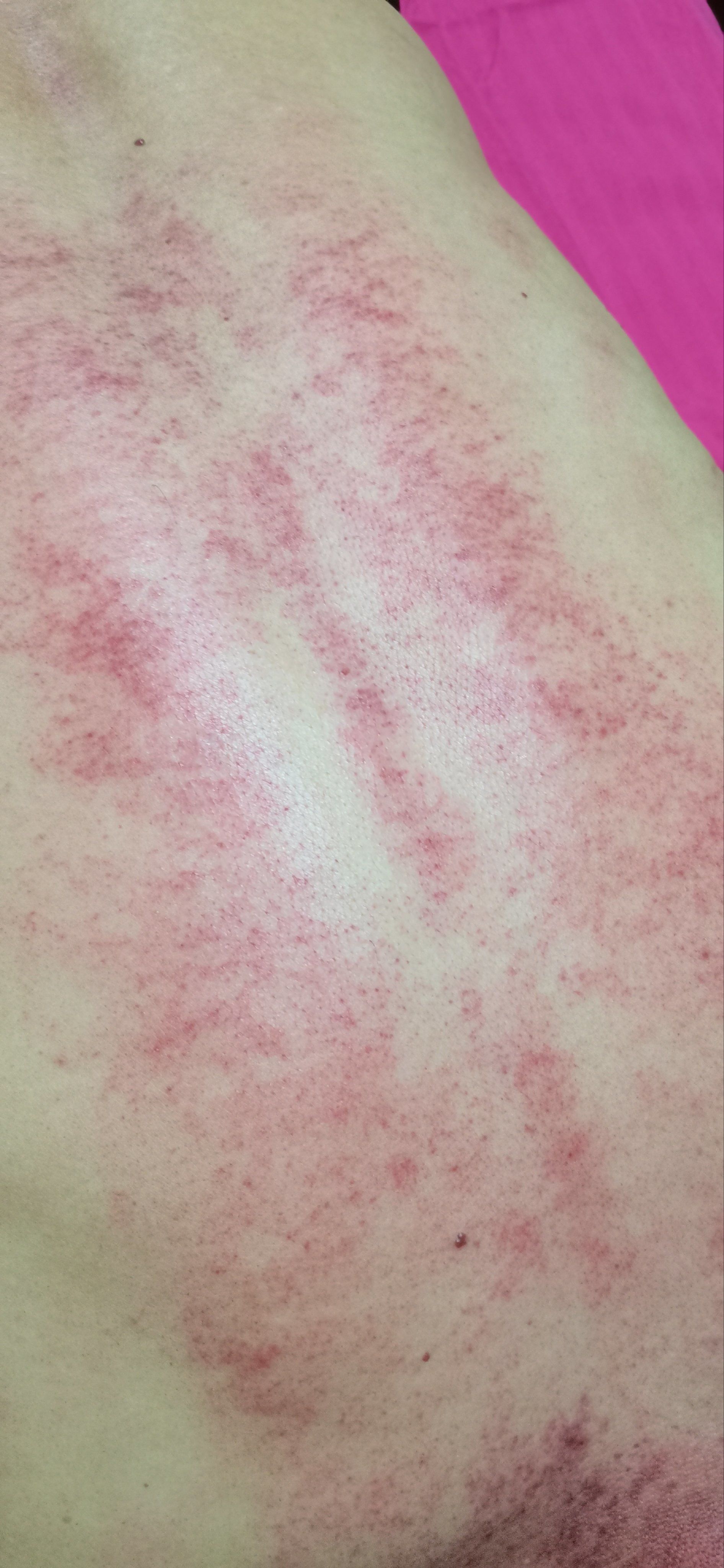 保持健康,从刮痧开始