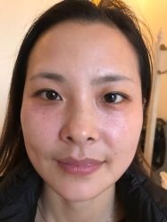 -美丽人生祛斑扁平疣汗管瘤中心