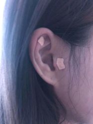 -肥三针腧穴瘦身馆