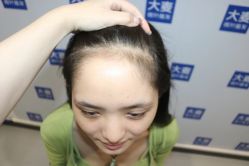 -大麦微针植发全国连锁