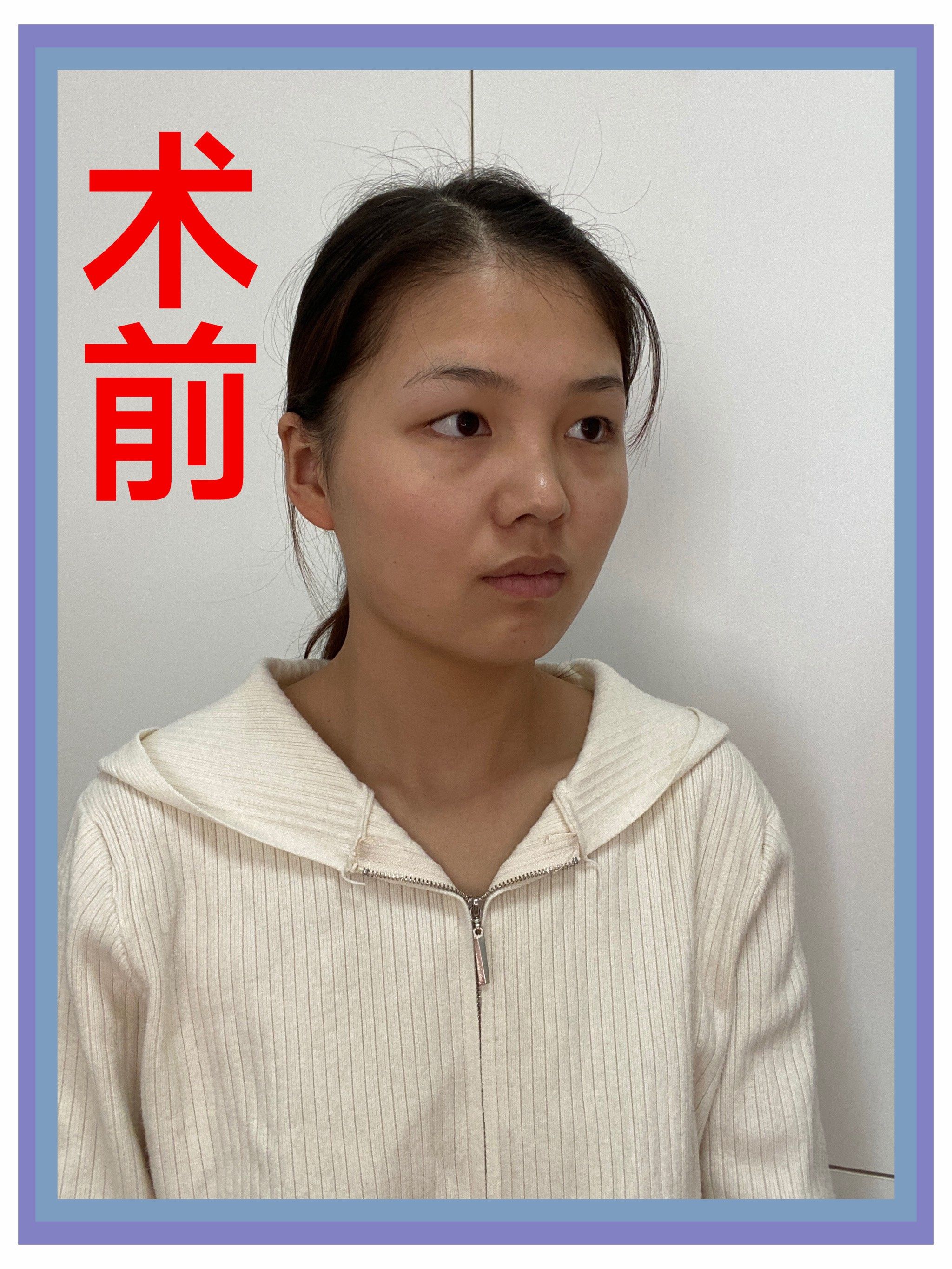 【眼综合四项】术后35天
