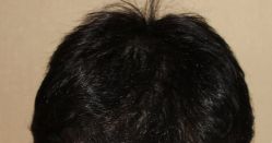 -大麦微针植发丨全国连锁