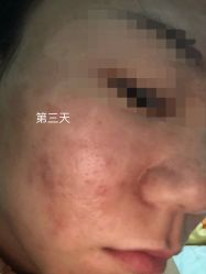 体验后-北京英煌医疗美容