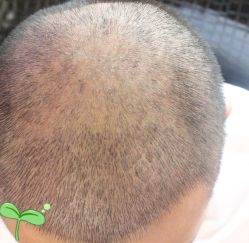 -大麦微针植发丨全国连锁