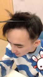 点击看大图 -大麦微针植发丨全国连锁