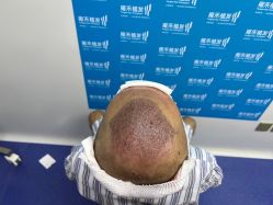 -雍禾植发全国连锁