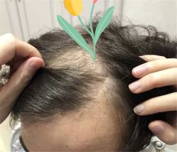 点击看大图 -大麦微针植发全国连锁