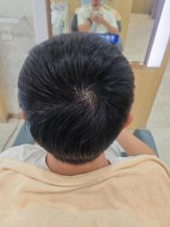 -大麦微针植发丨全国连锁