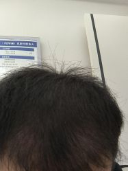 体验后-大麦微针植发丨全国连锁