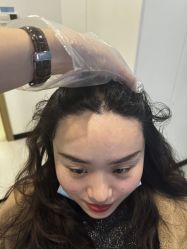 -大麦微针植发全国连锁