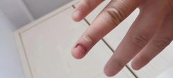 -德哥灰指甲脚气甲沟炎跖疣护理