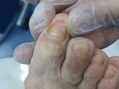 -Andrew指甲专科灰指甲·甲沟炎矫正·3D步态矫形鞋垫定制(浦三路店)