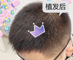 -大麦微针植发全国连锁