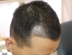 -大麦微针植发丨全国连锁