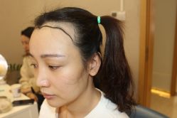 -大麦微针植发丨全国连锁