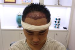 -大麦微针植发丨全国连锁