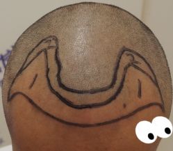 -大麦微针植发全国连锁