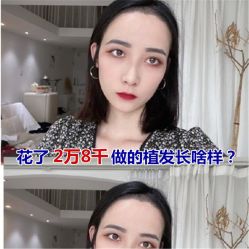 -碧莲盛·不剃发植发