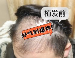 -大麦微针植发全国连锁