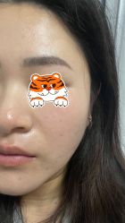 体验后-肌密·水光·祛痘·黄金微针