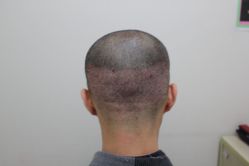 点击看大图 -大麦微针植发丨全国连锁