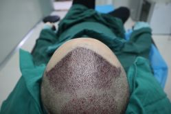 -大麦微针植发全国连锁