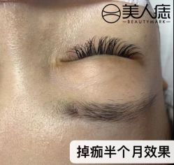 -美人痣全国连锁