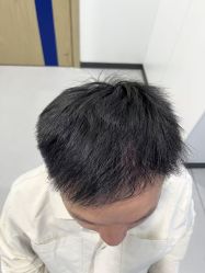 -大麦微针植发全国连锁