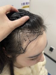 体验前-大麦微针植发全国连锁