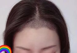 -大麦微针植发丨全国连锁