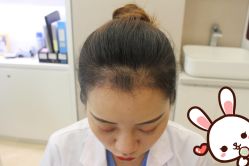 点击看大图 -大麦微针植发丨全国连锁