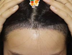 -大麦微针植发全国连锁
