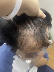 体验前-大麦微针植发全国连锁