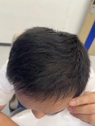 -大麦微针植发全国连锁