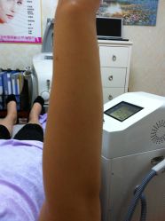 -薇兰专业脱毛连锁机构