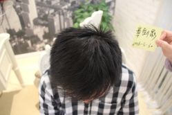 点击看大图 -大麦微针植发丨全国连锁