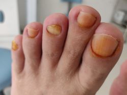 -派恩宜灰指甲鸡眼嵌甲手足癣