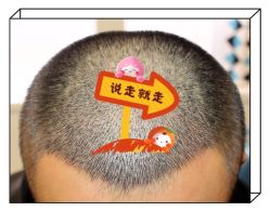 -大麦微针植发全国连锁