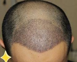 -大麦微针植发丨全国连锁