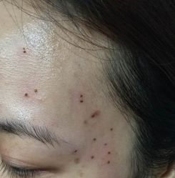 -北京美痣堂古方祛痣斑疣瘊