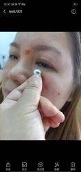 -百年美肤堂祛痦痣祛斑祛疣