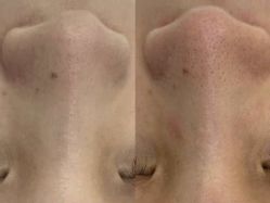 -凡碧诗毛孔清洁收细