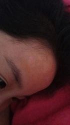 -北京美痣堂古方祛痣斑疣瘊