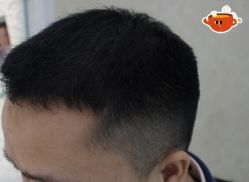 -大麦微针植发丨全国连锁