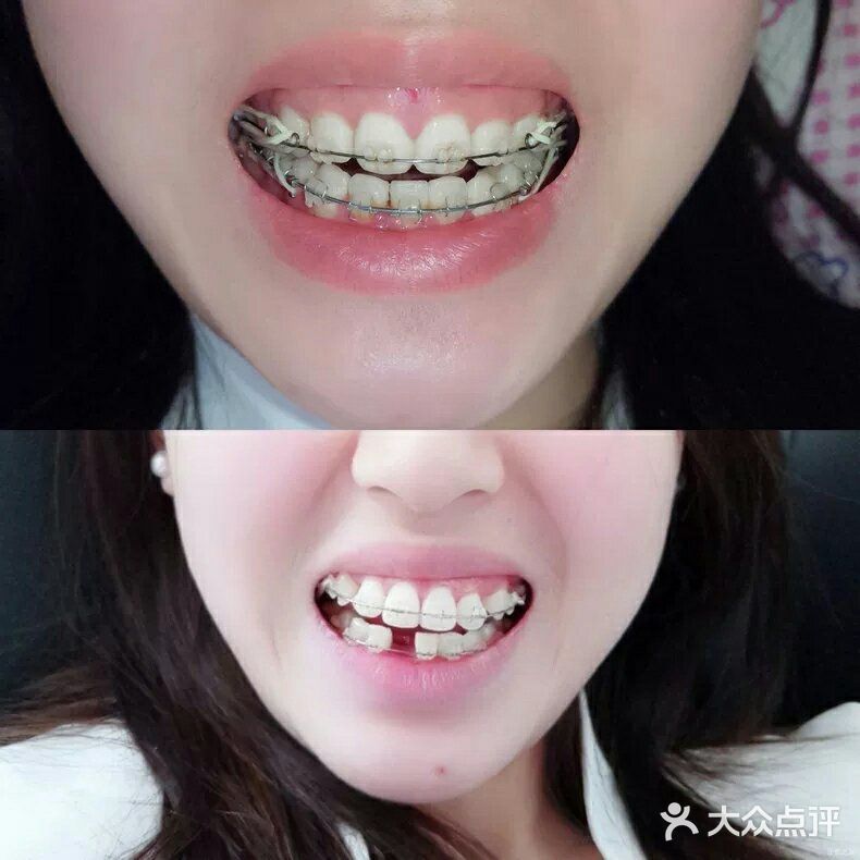 如何有效提升牙齿矫正效率？ .