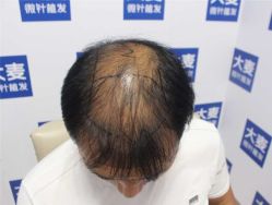 体验前-大麦微针植发丨全国连锁